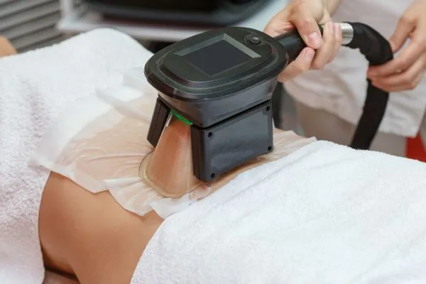 Image of person having fat freezing treatment to help weight gain Birmingham