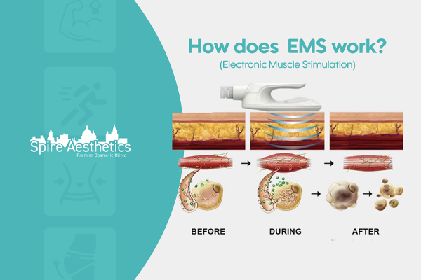 EMS treatment for post pregnancy weight loss treatment Birmingham