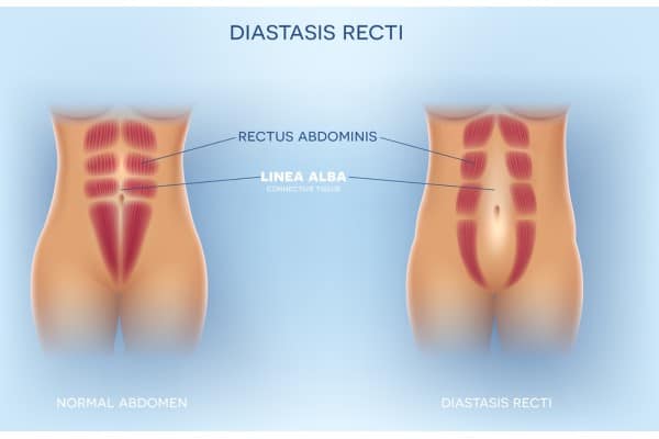 What Non-Surgical Options Are Available for Diastasis Recti Birmingham?