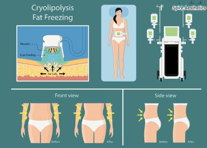 Image of diet and fat freezing combined for best results for Spire Aesthetics Birmingham