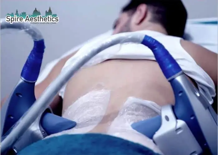 Man having fat freezing treatment done on love handles before a competitions Birmingham to create a sculpted look.