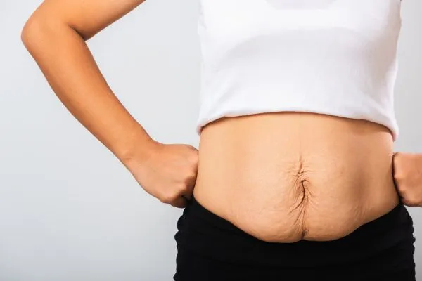 Image of a woman's stomach after weight loss with sagging skin following a gastric band Birmingham