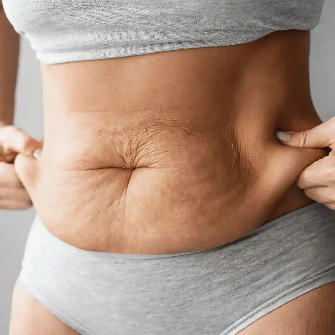 Is It Normal to Have Loose Skin After Pregnancy Birmingham?