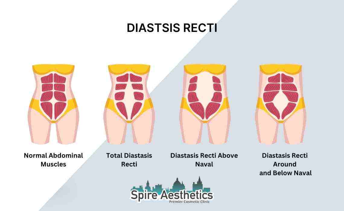 Is Non-Surgical Diastasis Recti Treatment Right for You? Common Concerns Answered Birmingham